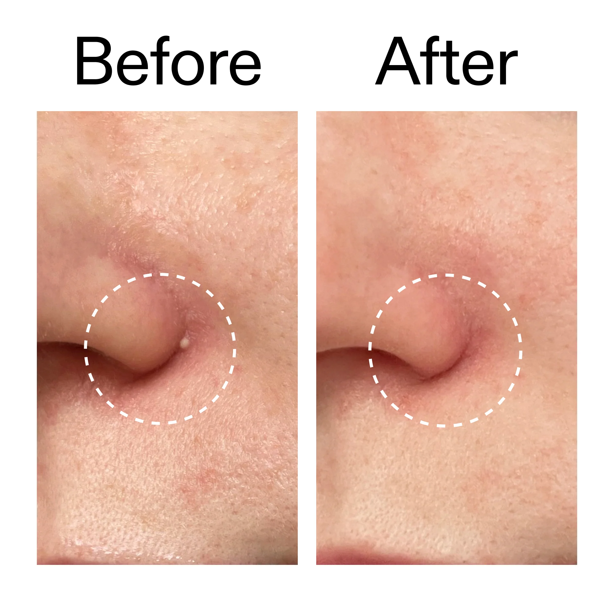 Hydrocolloid Invisible Pimple Patches Duo - Image 9